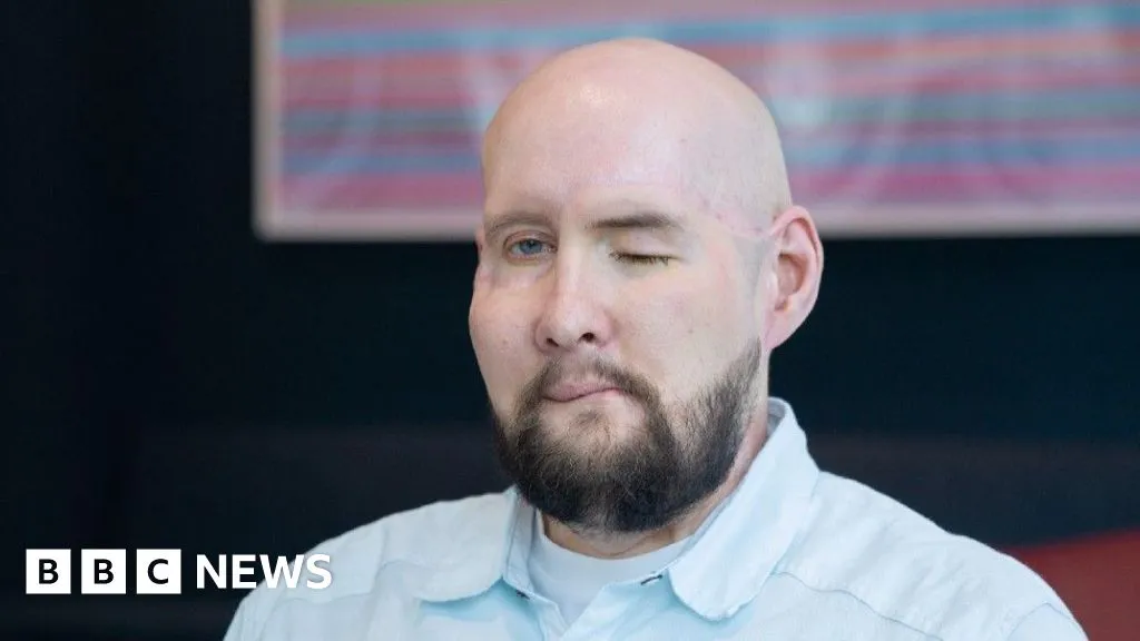 US veteran sees 'remarkable' progress after first eye transplant