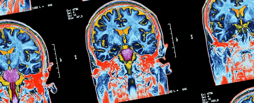 Hidden Consciousness Detected in 25% of Unresponsive Patients Tested