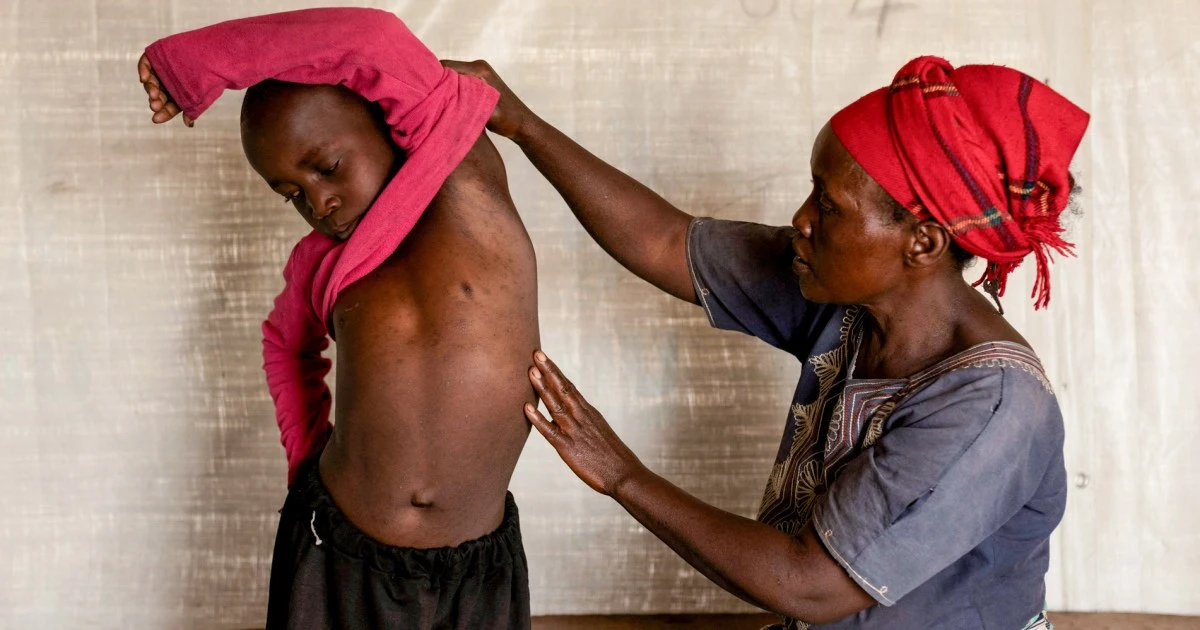 CDC, WHO mull stronger mpox warnings as deadlier strain continues to spread